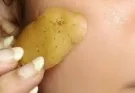 Does applying potato on the face reduce blemishes? Find out