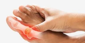 It is very important for uric acid patients to take special care of their diet.